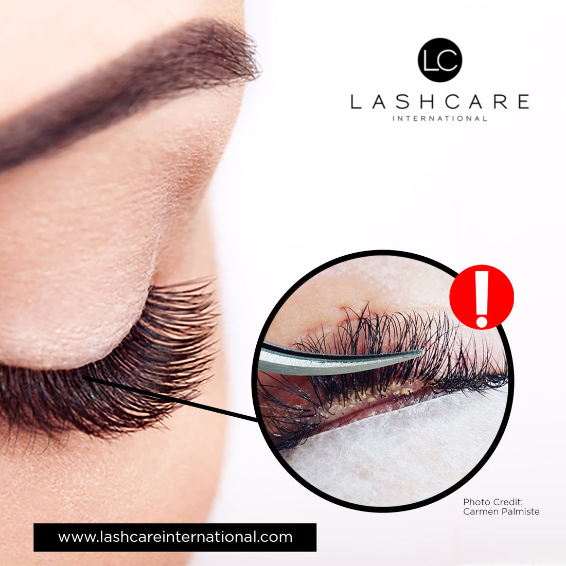 Say Goodbye To Blepharitis: How Lash Care International's Cleanser Can Help